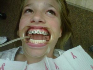Getting braces put on can be a daunting process, but in the long run it is worth it. Courtesy photos